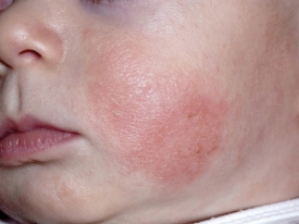 10 biểu hiện của bệnh viêm da cơ địa ở trẻ nhỏ