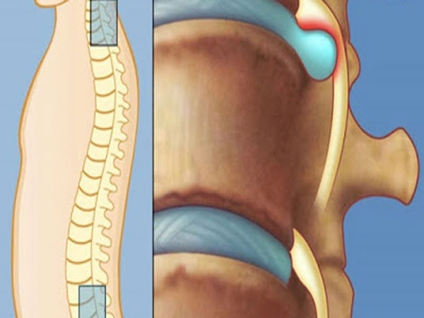 dấu hiệu của bệnh đau dây thần kinh liên sườn 1