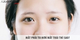 Mắt phải to hơn mắt trái thì sao?