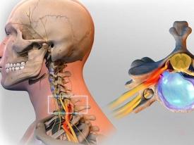 Nguyên nhân gây bệnh thoát vị đĩa đệm cột sống cổ và cách điều trị